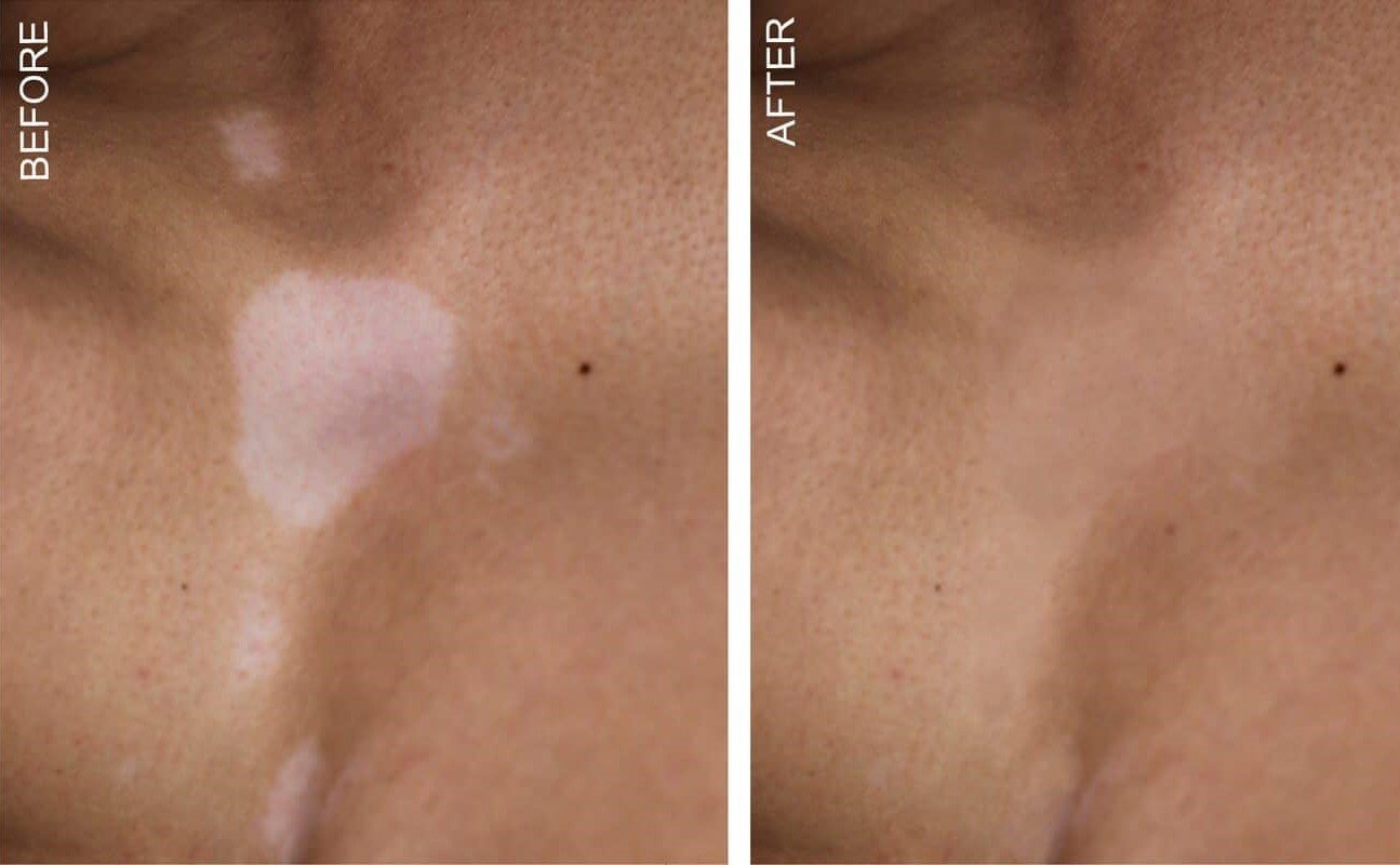 MA-Vitilligo-Banner-Stan